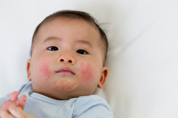 dziecko z objawami alergii