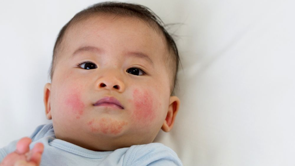 dziecko z objawami alergii